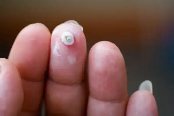 Image of white wart before cryopen treatment Weston Super Mare
