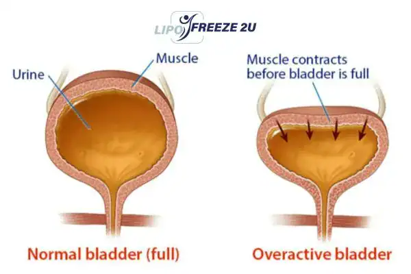 diagram of overactive bladder treatment Weston Super Mare