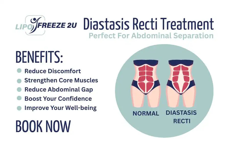 How Long Will It Take to See Improvements in Diastasis Recti Weston Super Mare