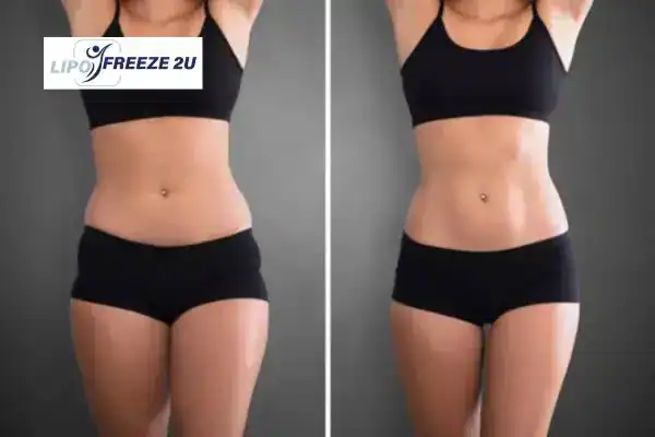 How Can LIPO FREEZE 2U Support Your Post-Pregnancy Body Recovery Weston Super Mare?