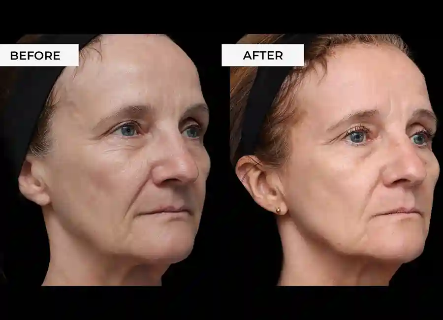 How Many RF Microneedling Sessions Will You Need to See a Difference Weston Super Mare?