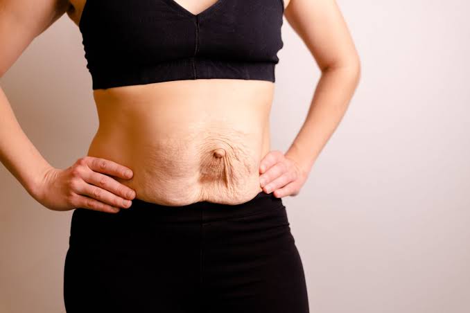 Is Surgery Really the Only Way to Repair Diastasis Recti Weston Super Mare?