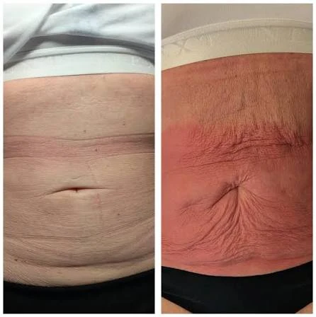 How Does RF Microneedling Improve Crepey, Thin and Uneven Skin Texture Weston Super Mare?