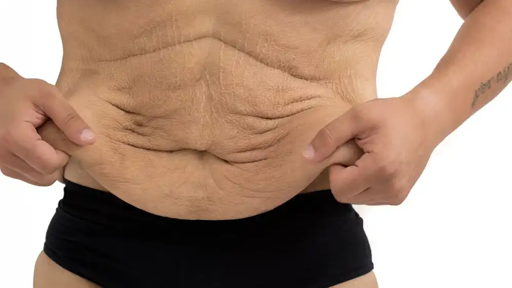 RF Microneedling for Loose Skin: How Can It Help Tighten and Reshape the Skin Weston Super Mare?